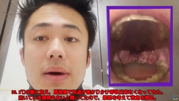 フィッシャーズ・シルクが大けが！過去には救急搬送されていた？